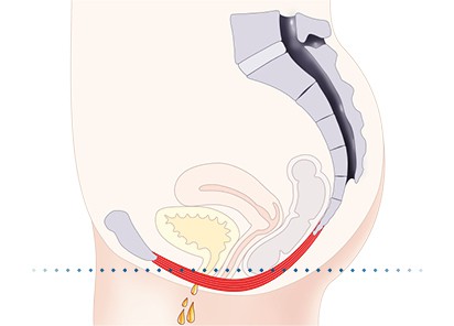 Pelvic-Floor Muscle Repair 5 Pelvic floor muscles Colchester
