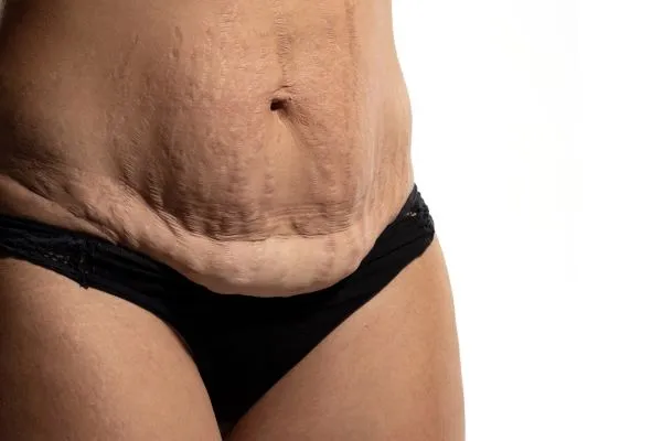 The science behind skin tightening Colchester picture of a woman's sagging skin on the stomach